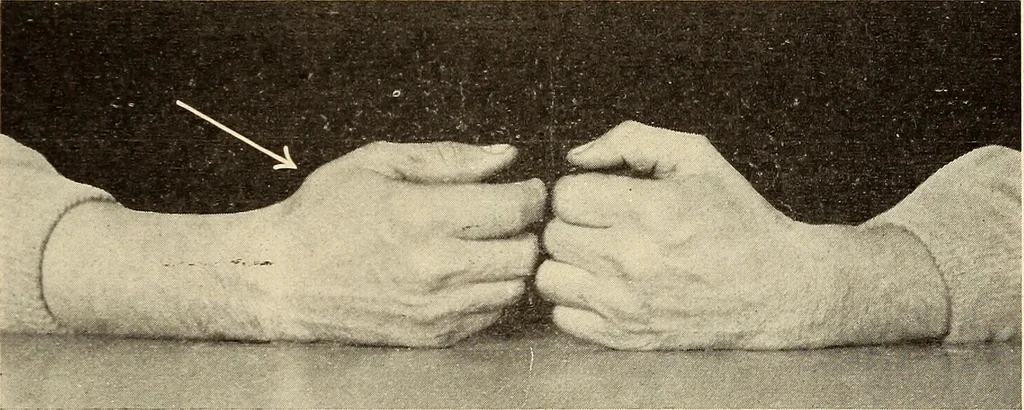 An illustration from Fractures and dislocations, diagnosis and treatment, 1915, leaf 330