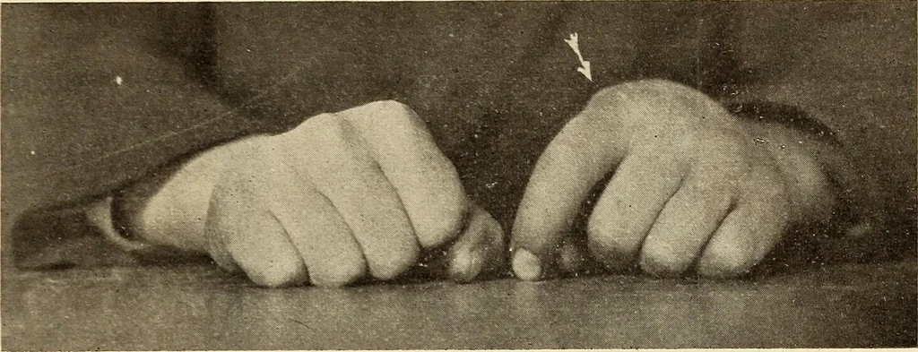 An illustration from Fractures and dislocations, diagnosis and treatment, 1915, leaf 332