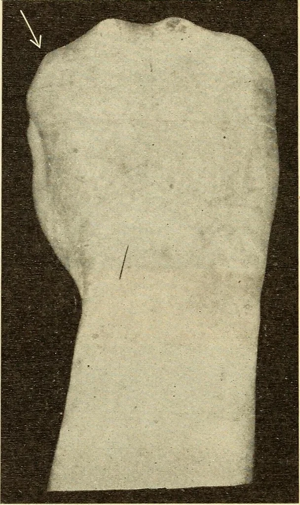 An illustration from Fractures and dislocations, diagnosis and treatment, 1915, leaf 333