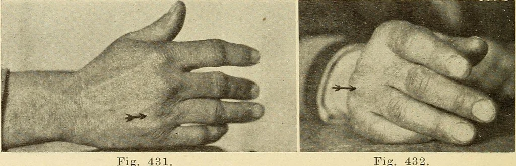 An illustration from Fractures and dislocations, diagnosis and treatment, 1915, leaf 333