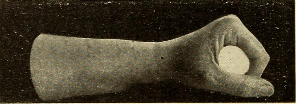 An illustration from Fractures and dislocations, diagnosis and treatment, 1915, leaf 335