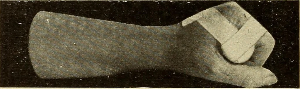 An illustration from Fractures and dislocations, diagnosis and treatment, 1915, leaf 335