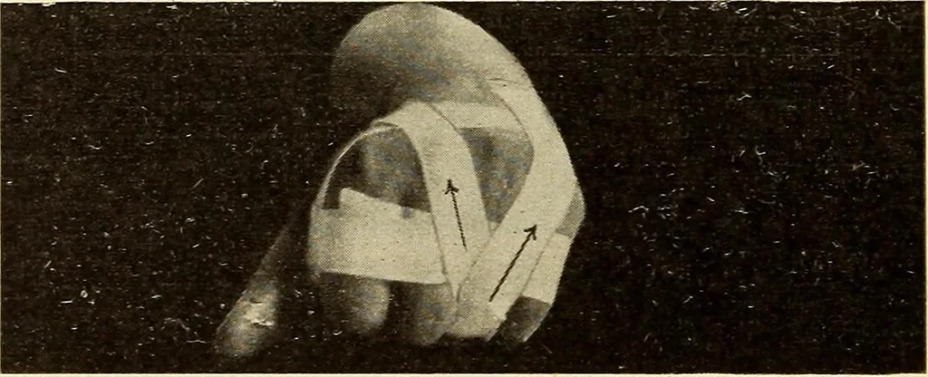 An illustration from Fractures and dislocations, diagnosis and treatment, 1915, leaf 335