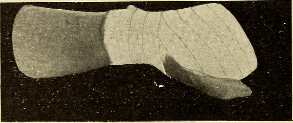 An illustration from Fractures and dislocations, diagnosis and treatment, 1915, leaf 335