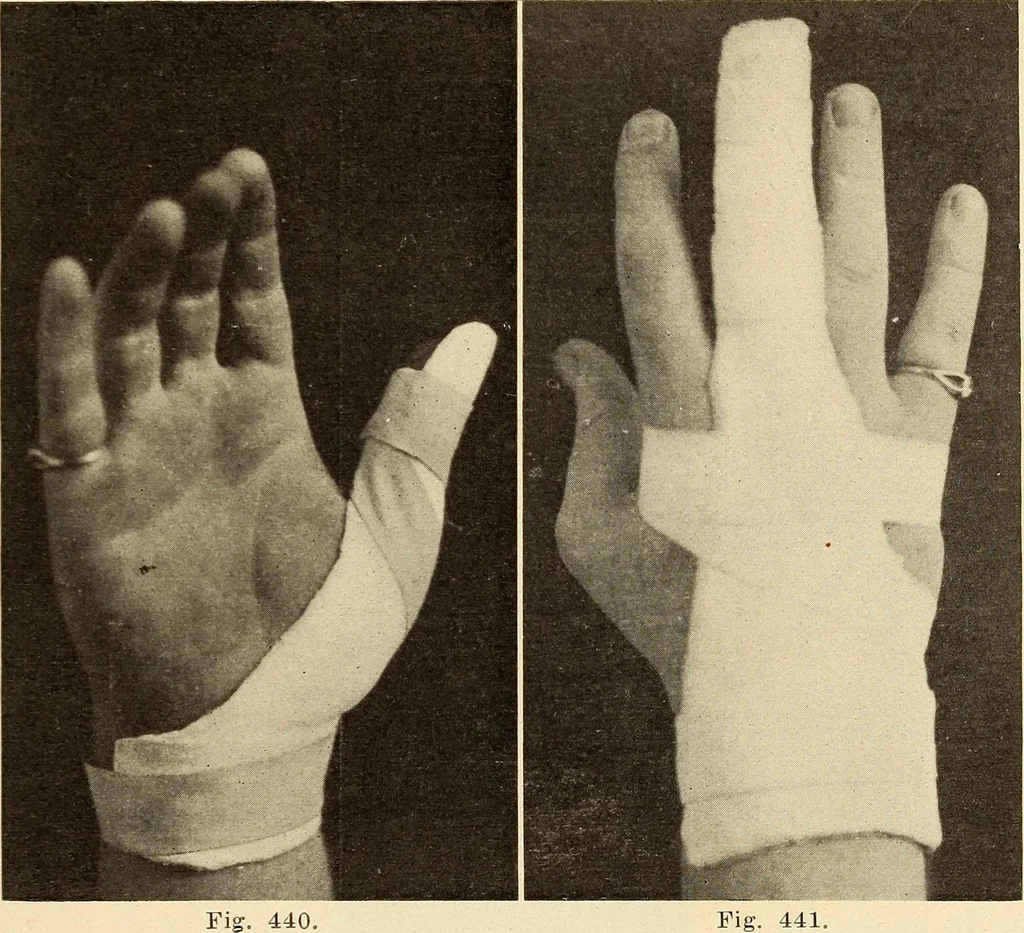 An illustration from Fractures and dislocations, diagnosis and treatment, 1915, leaf 340