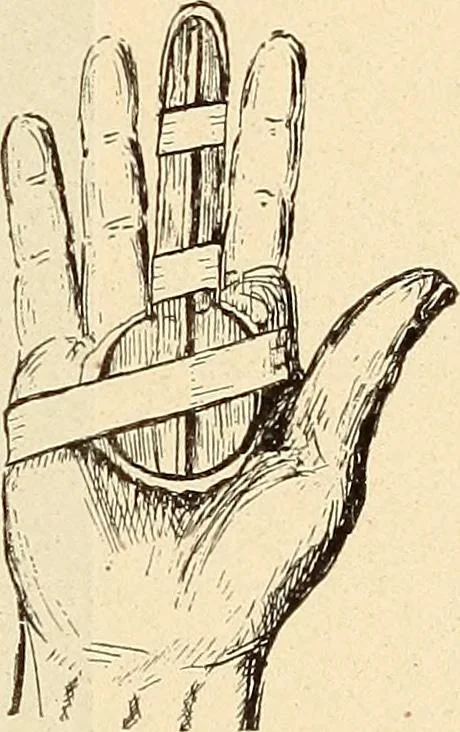 An illustration from Fractures and dislocations, diagnosis and treatment, 1915, leaf 342