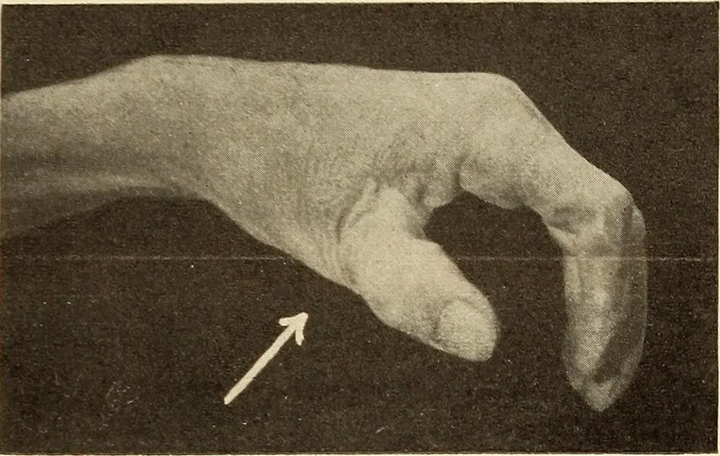 An illustration from Fractures and dislocations, diagnosis and treatment, 1915, leaf 346