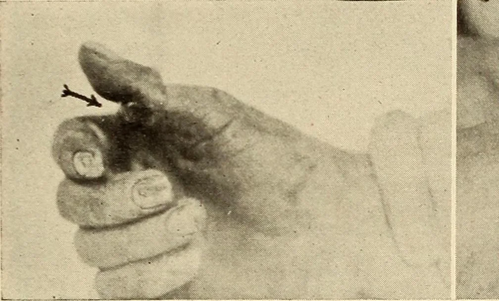 An illustration from Fractures and dislocations, diagnosis and treatment, 1915, leaf 346