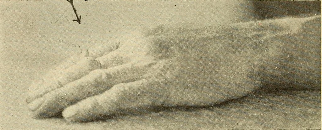 An illustration from Fractures and dislocations, diagnosis and treatment, 1915, leaf 347