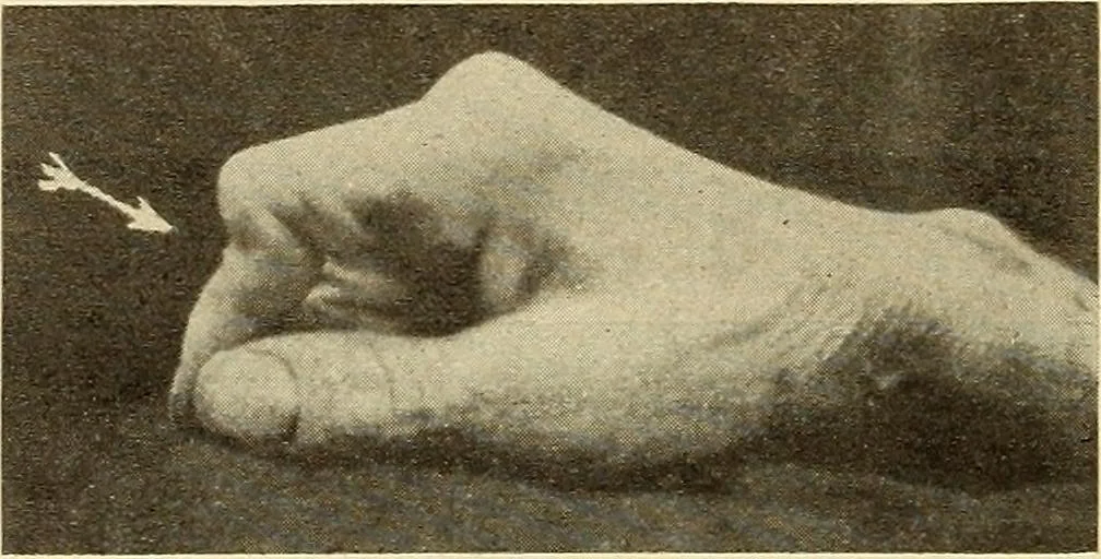An illustration from Fractures and dislocations, diagnosis and treatment, 1915, leaf 347