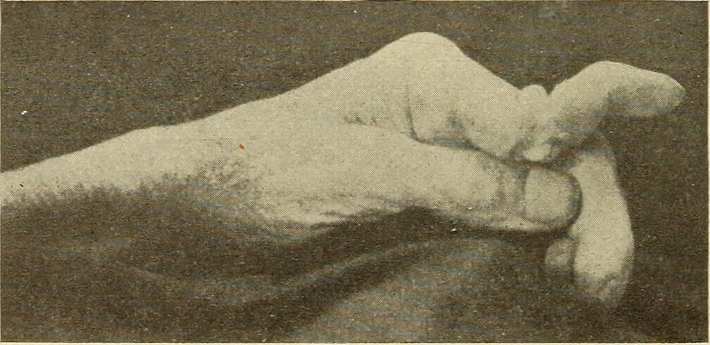 An illustration from Fractures and dislocations, diagnosis and treatment, 1915, leaf 347