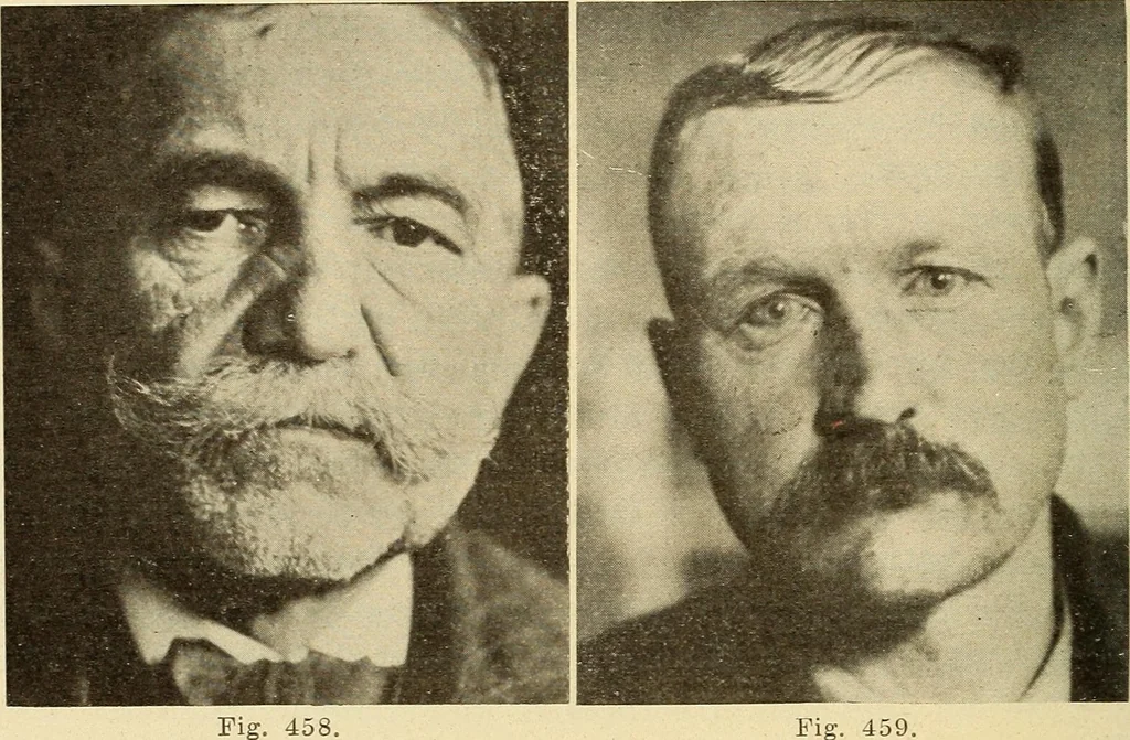 An illustration from Fractures and dislocations, diagnosis and treatment, 1915, leaf 357