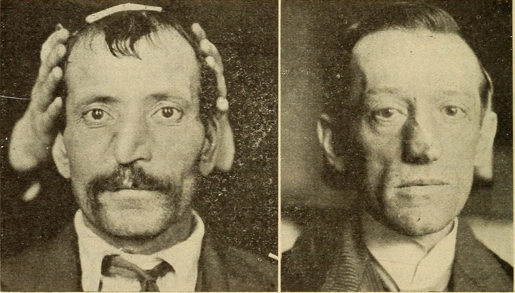 An illustration from Fractures and dislocations, diagnosis and treatment, 1915, leaf 357