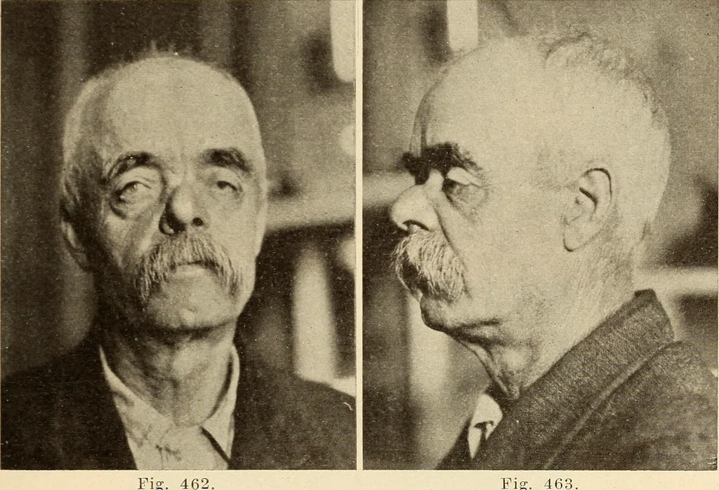 An illustration from Fractures and dislocations, diagnosis and treatment, 1915, leaf 358