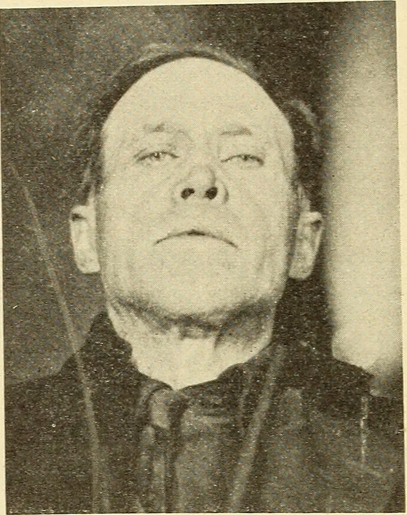 An illustration from Fractures and dislocations, diagnosis and treatment, 1915, leaf 359