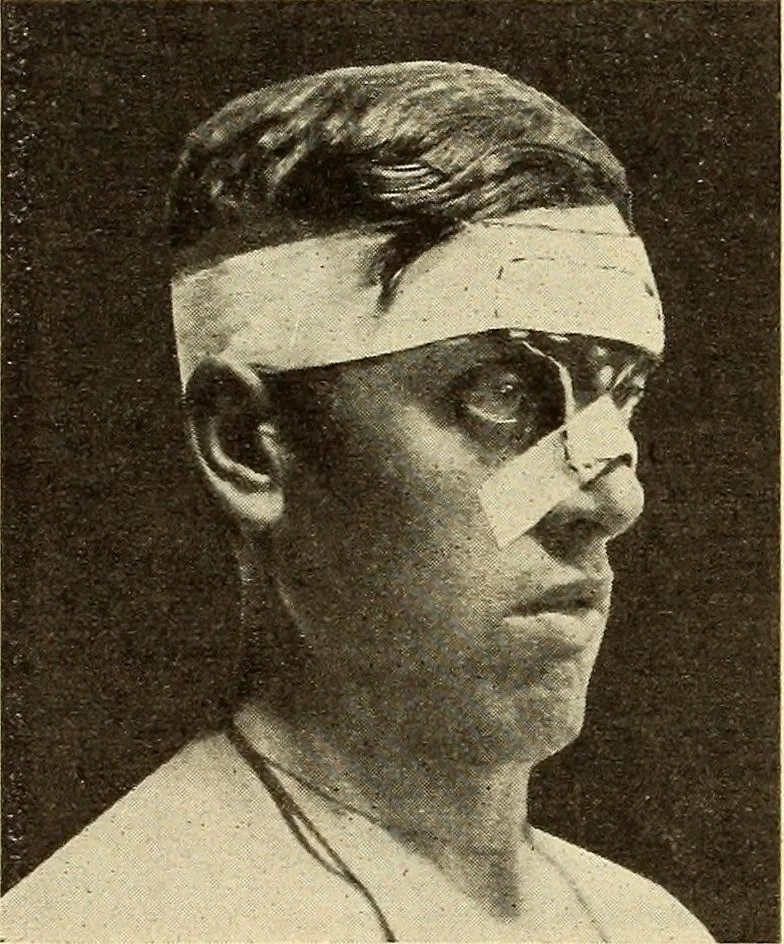 An illustration from Fractures and dislocations, diagnosis and treatment, 1915, leaf 361