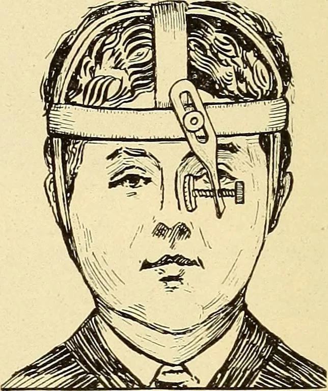 An illustration from Fractures and dislocations, diagnosis and treatment, 1915, leaf 361