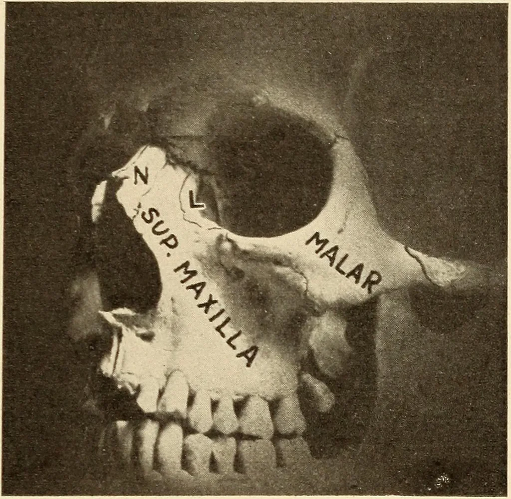 An illustration from Fractures and dislocations, diagnosis and treatment, 1915, leaf 366