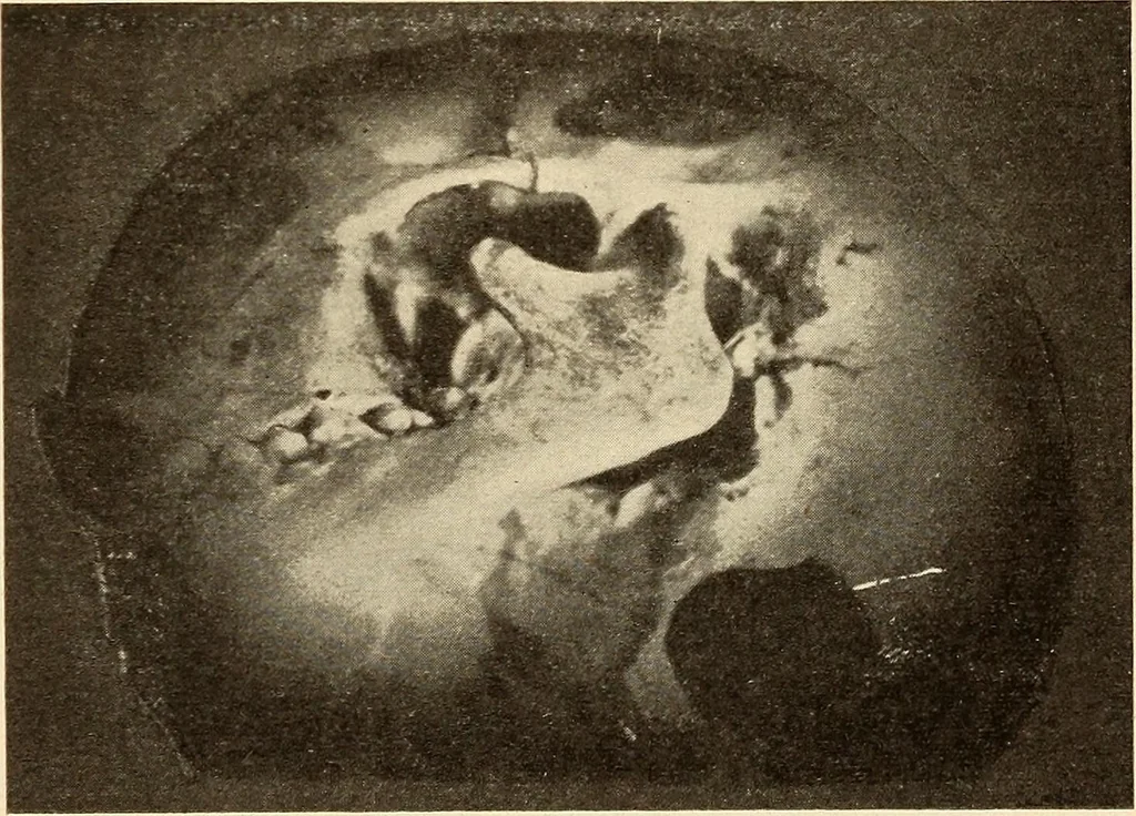 An illustration from Fractures and dislocations, diagnosis and treatment, 1915, leaf 366
