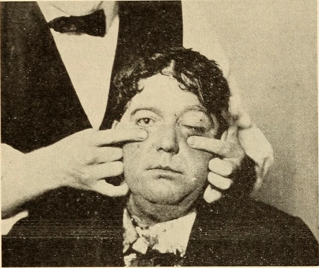 An illustration from Fractures and dislocations, diagnosis and treatment, 1915, leaf 368