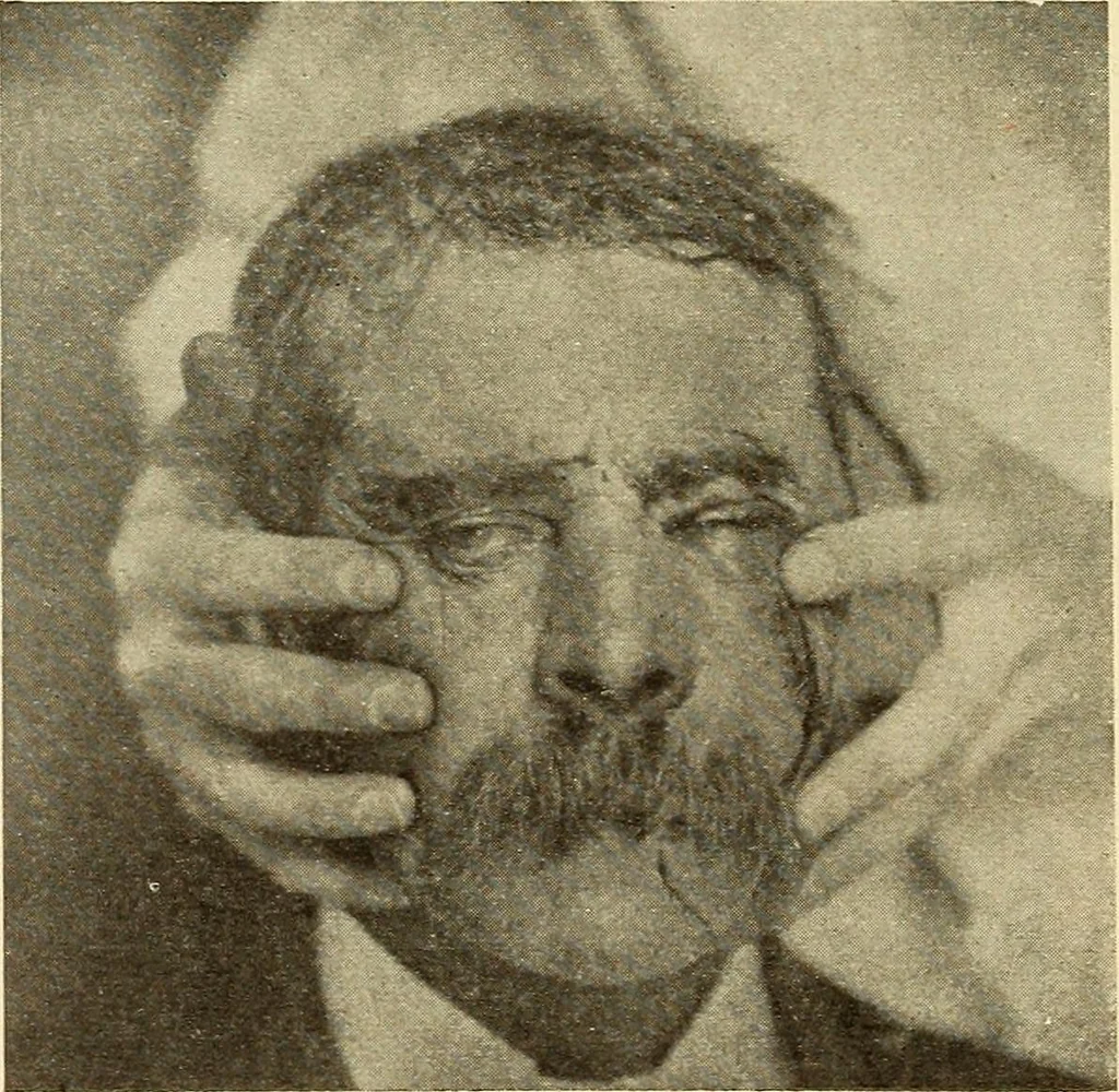 An illustration from Fractures and dislocations, diagnosis and treatment, 1915, leaf 369