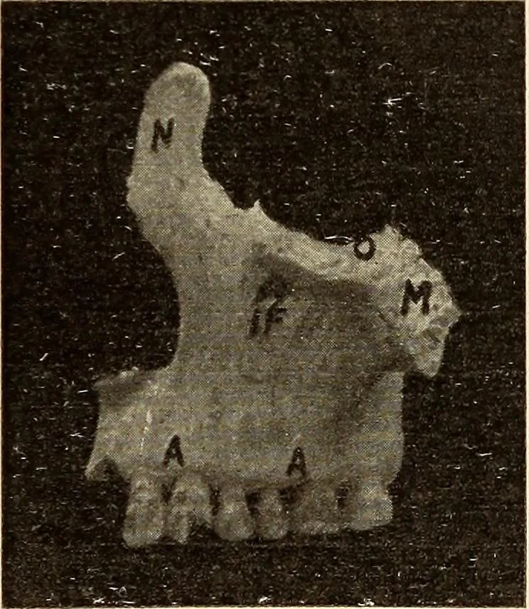 An illustration from Fractures and dislocations, diagnosis and treatment, 1915, leaf 374