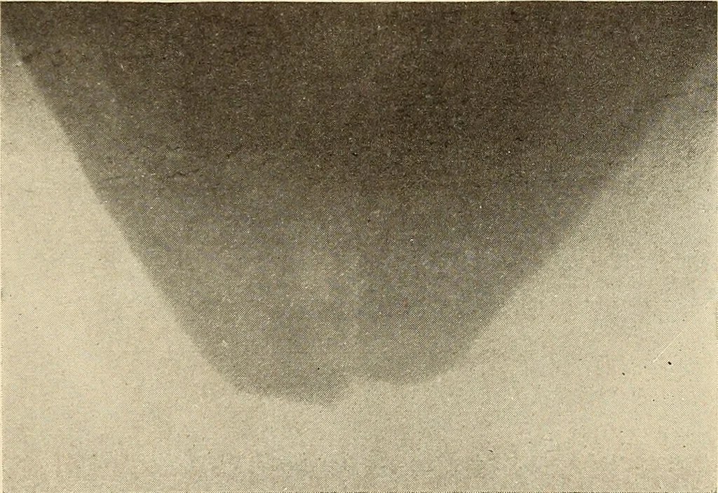 An illustration from Fractures and dislocations, diagnosis and treatment, 1915, leaf 382