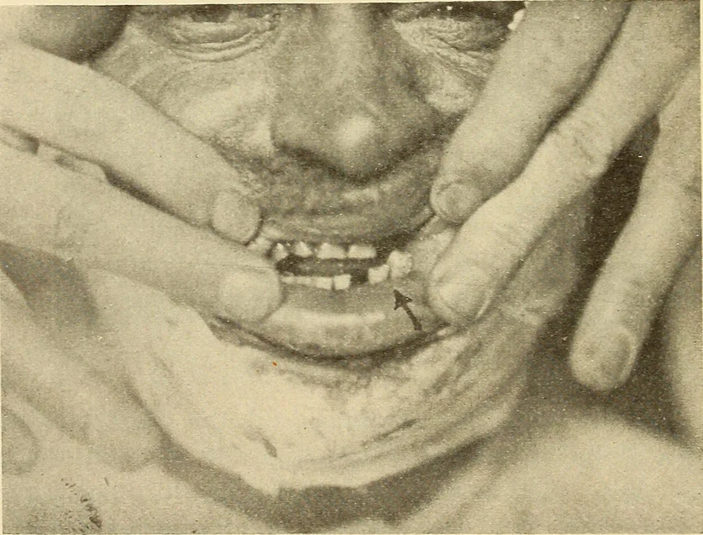 An illustration from Fractures and dislocations, diagnosis and treatment, 1915, leaf 383