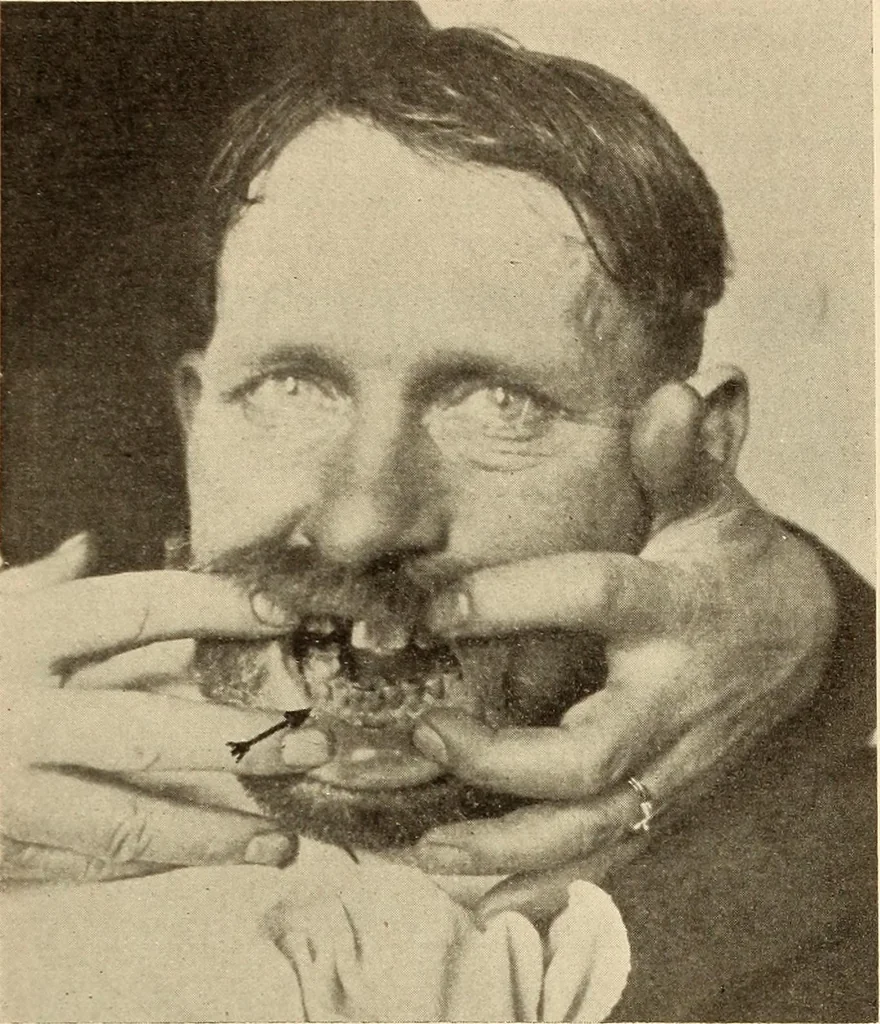 An illustration from Fractures and dislocations, diagnosis and treatment, 1915, leaf 386