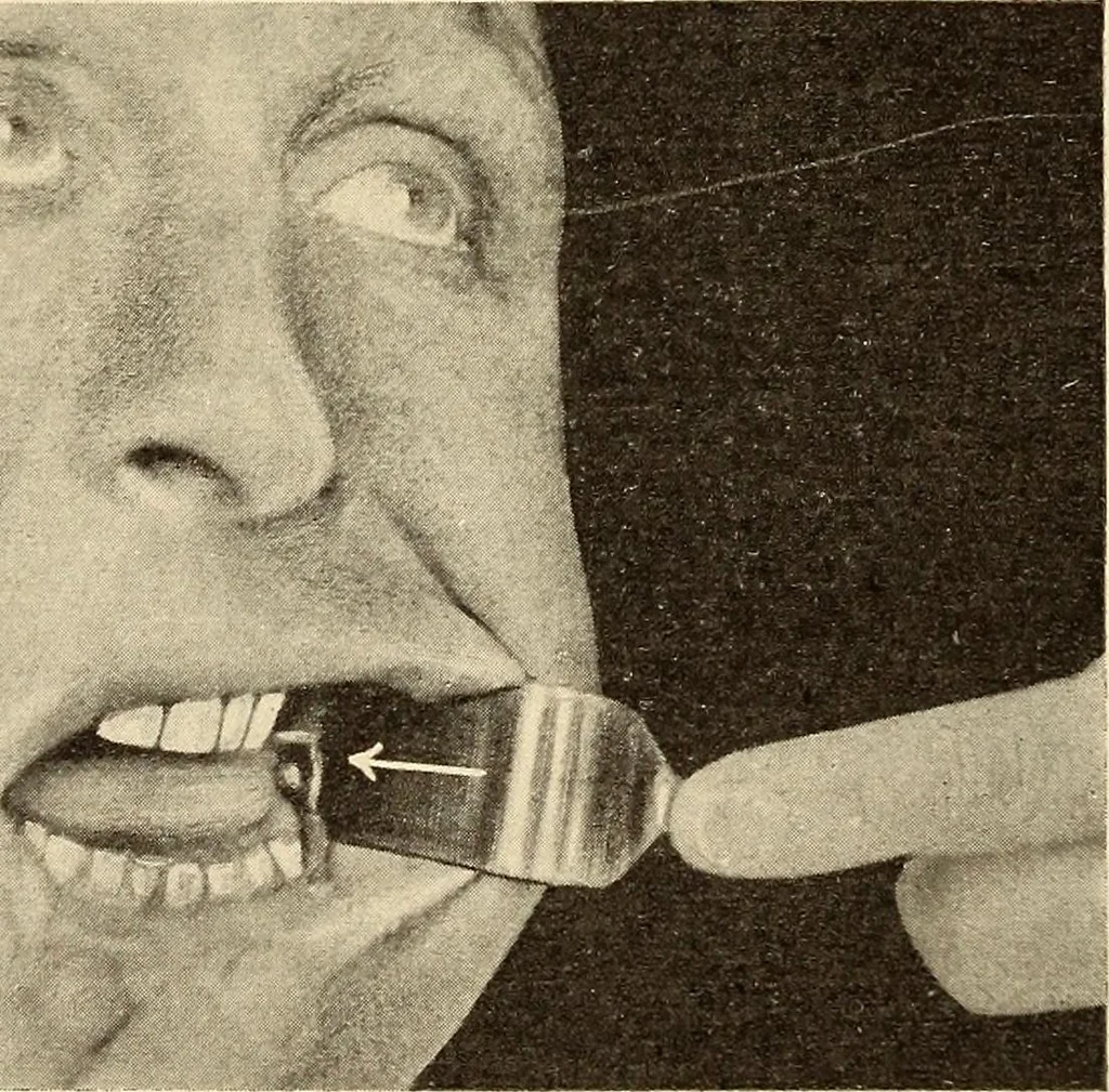 An illustration from Fractures and dislocations, diagnosis and treatment, 1915, leaf 386