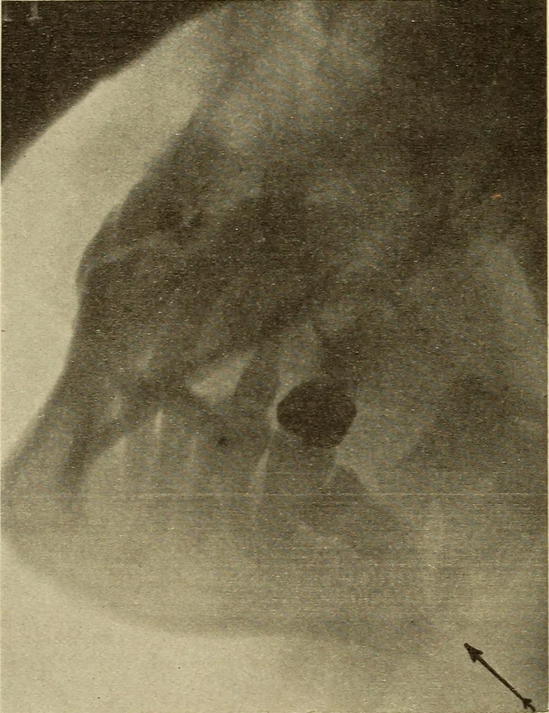 An illustration from Fractures and dislocations, diagnosis and treatment, 1915, leaf 387