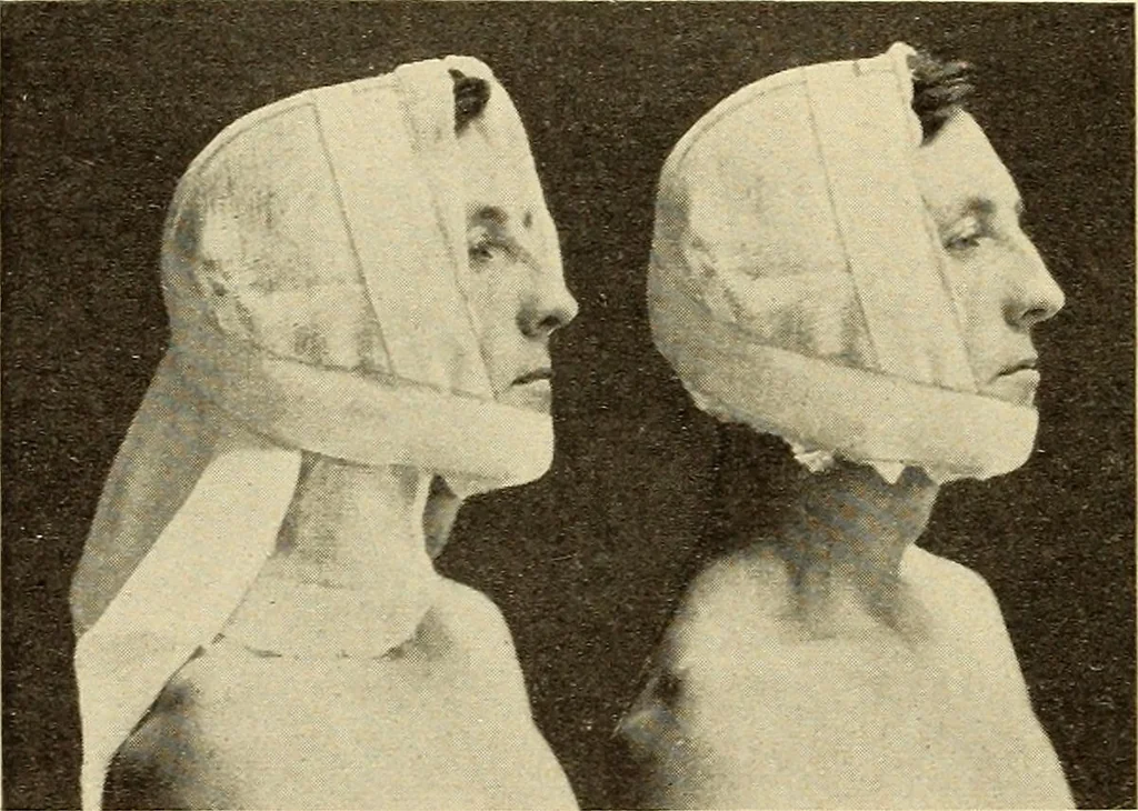 An illustration from Fractures and dislocations, diagnosis and treatment, 1915, leaf 389