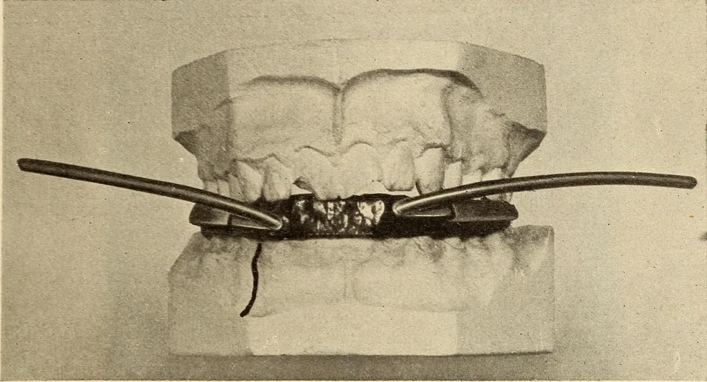 An illustration from Fractures and dislocations, diagnosis and treatment, 1915, leaf 392