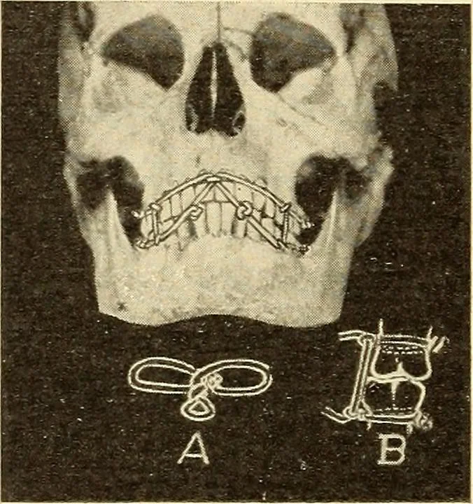 An illustration from Fractures and dislocations, diagnosis and treatment, 1915, leaf 397