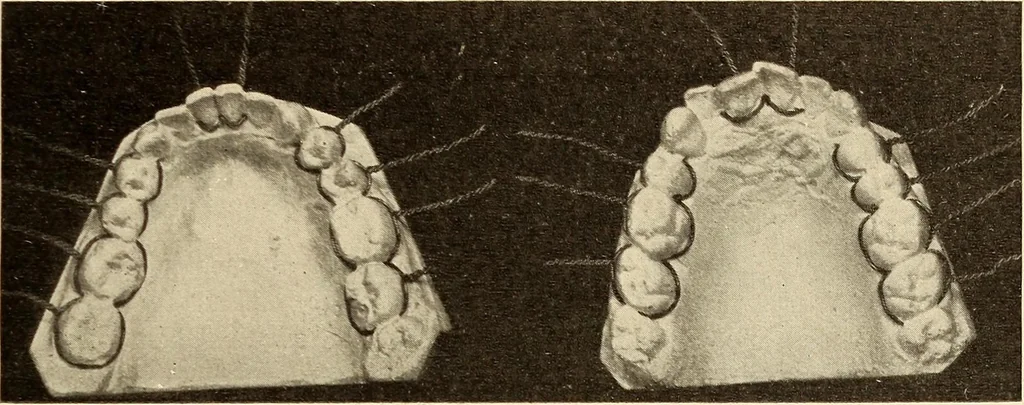 An illustration from Fractures and dislocations, diagnosis and treatment, 1915, leaf 400