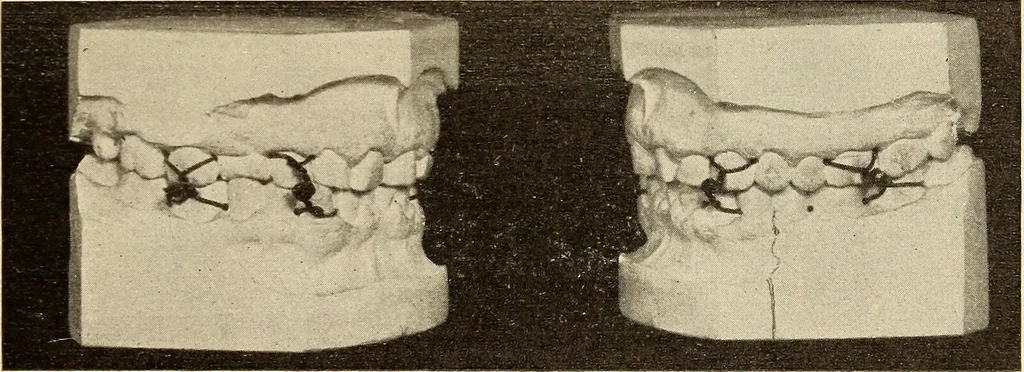 An illustration from Fractures and dislocations, diagnosis and treatment, 1915, leaf 400