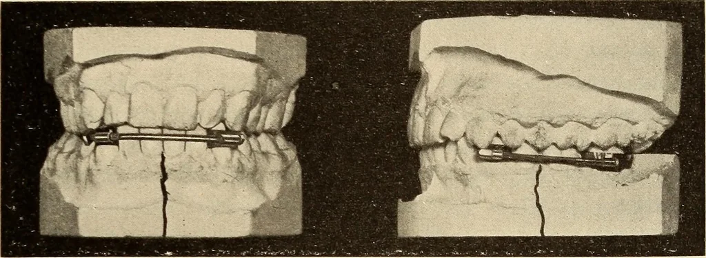 An illustration from Fractures and dislocations, diagnosis and treatment, 1915, leaf 402