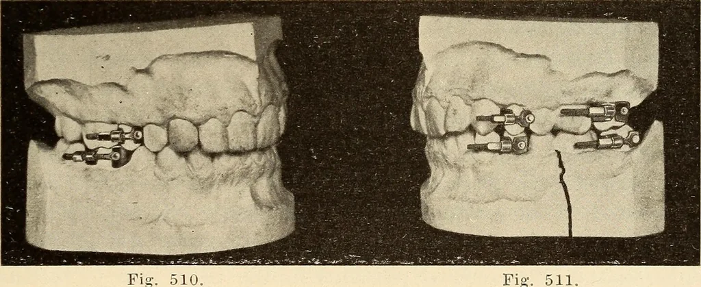 An illustration from Fractures and dislocations, diagnosis and treatment, 1915, leaf 402