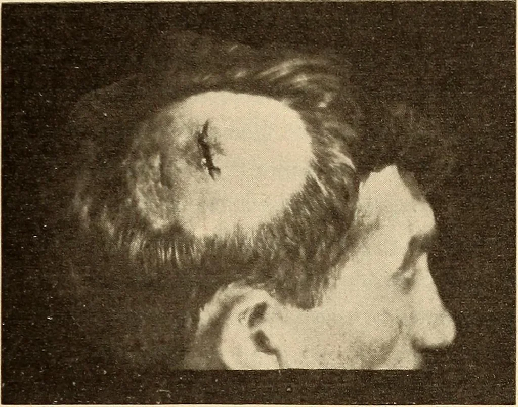 An illustration from Fractures and dislocations, diagnosis and treatment, 1915, leaf 418