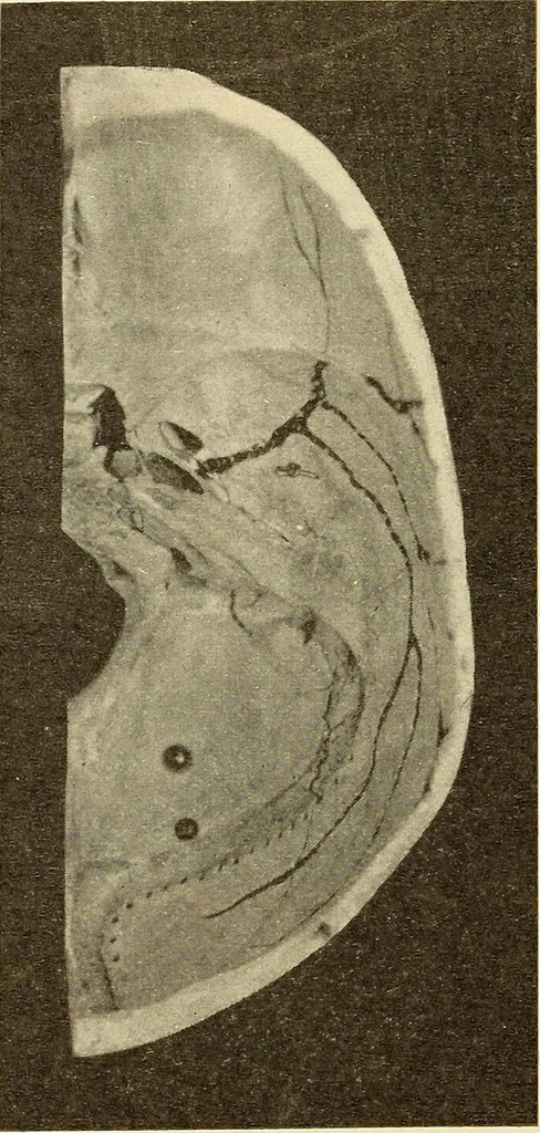 An illustration from Fractures and dislocations, diagnosis and treatment, 1915, leaf 429