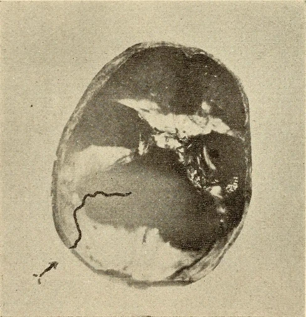 An illustration from Fractures and dislocations, diagnosis and treatment, 1915, leaf 446