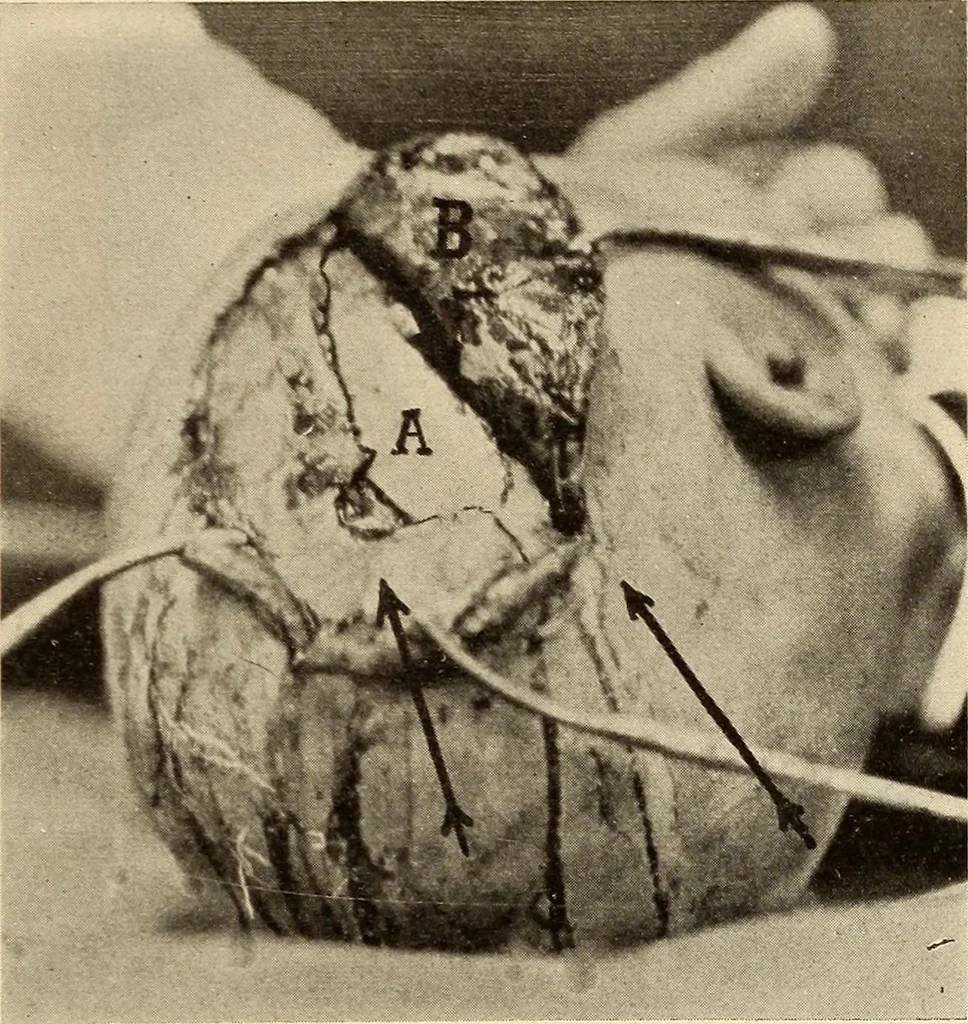 An illustration from Fractures and dislocations, diagnosis and treatment, 1915, leaf 448