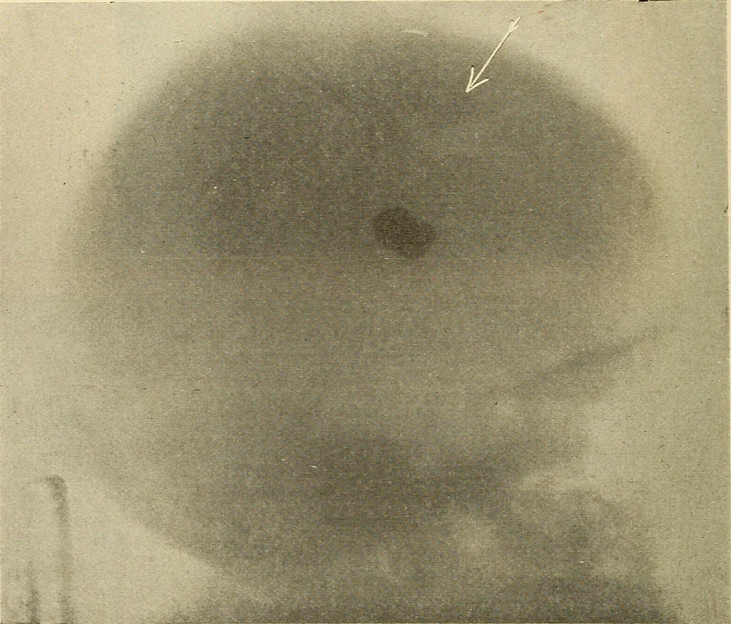 An illustration from Fractures and dislocations, diagnosis and treatment, 1915, leaf 449