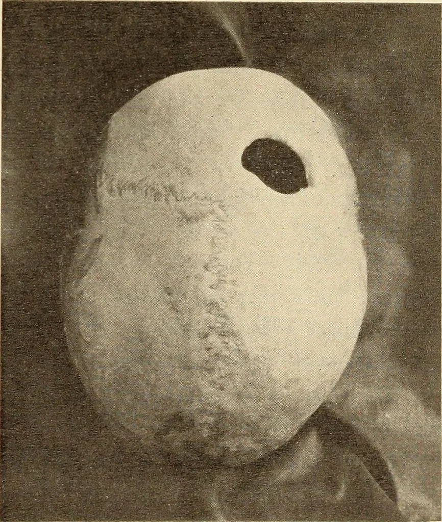 An illustration from Fractures and dislocations, diagnosis and treatment, 1915, leaf 450