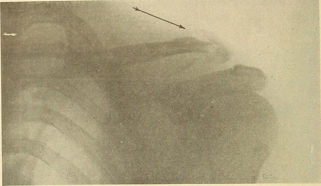 An illustration from Fractures and dislocations, diagnosis and treatment, 1915, leaf 47