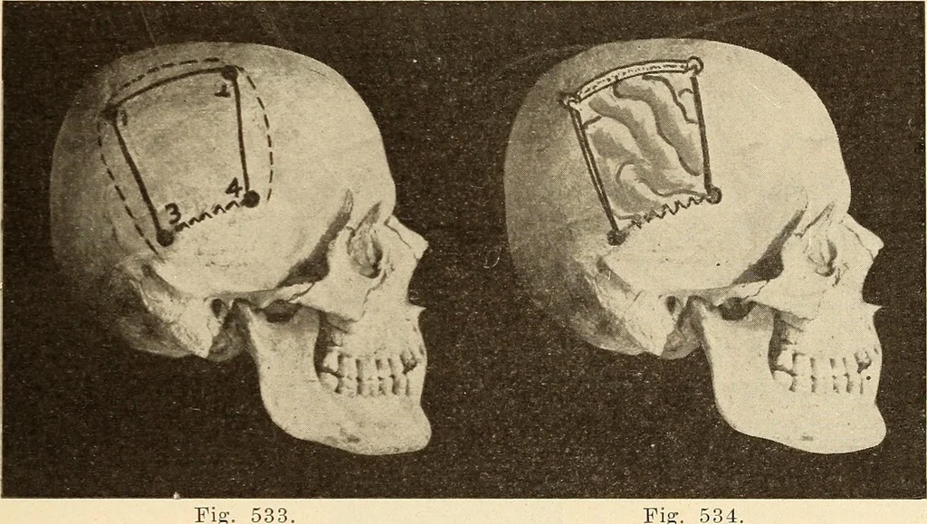 An illustration from Fractures and dislocations, diagnosis and treatment, 1915, leaf 478