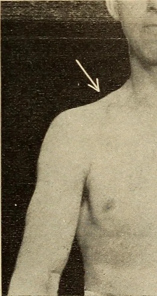 An illustration from Fractures and dislocations, diagnosis and treatment, 1915, leaf 48