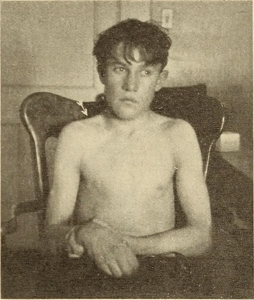 An illustration from Fractures and dislocations, diagnosis and treatment, 1915, leaf 48