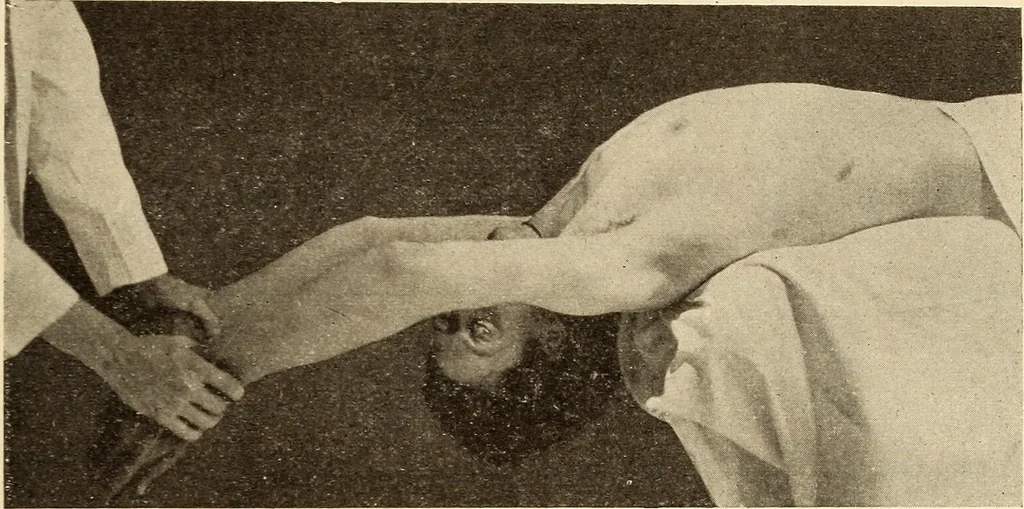 An illustration from Fractures and dislocations, diagnosis and treatment, 1915, leaf 488