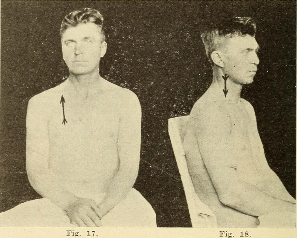 An illustration from Fractures and dislocations, diagnosis and treatment, 1915, leaf 49